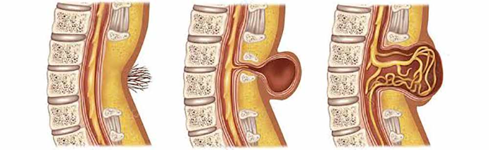 neural-tube-defect
